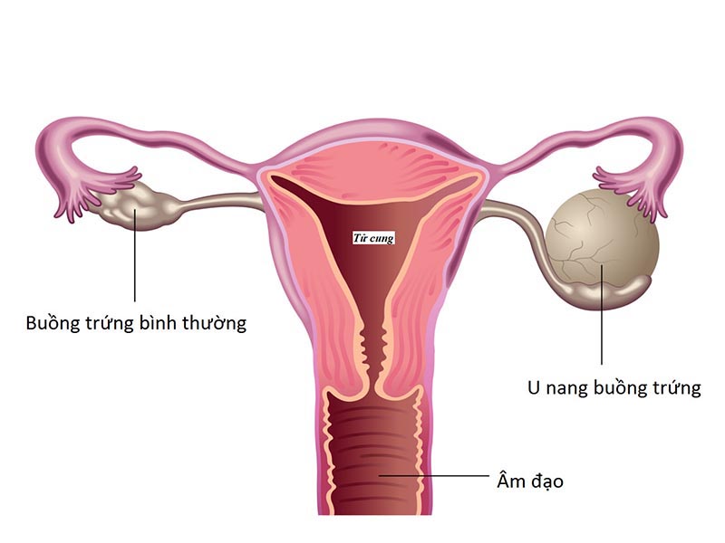 Hình ảnh minh họa về hình dạng buồng trứng bình thường và khi có u nang